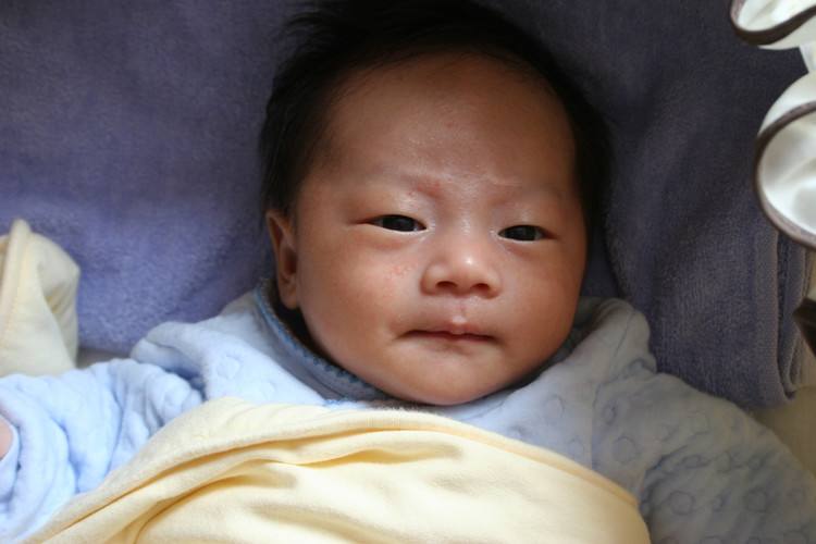 婴儿奶癣早期如何消除,什么是奶癣小儿奶癣该怎么办