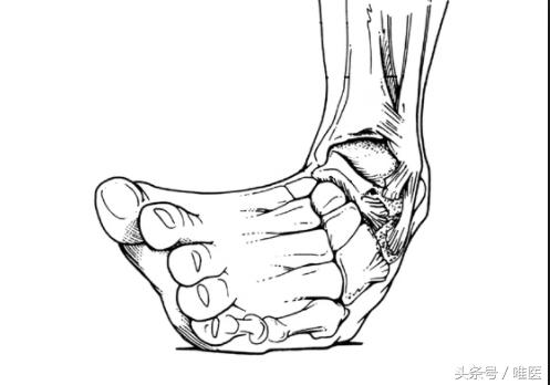 崴脚后千万不要推拿,崴脚后不能立刻按摩吗