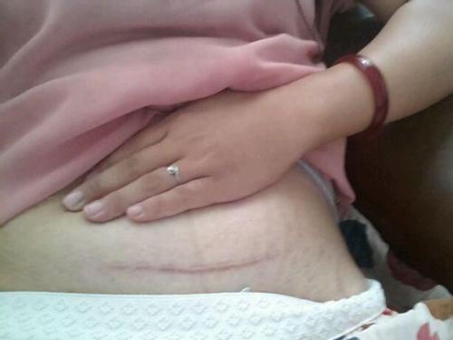 剖腹产横切好一点还是竖切好一点,剖腹产是横切还是竖切好