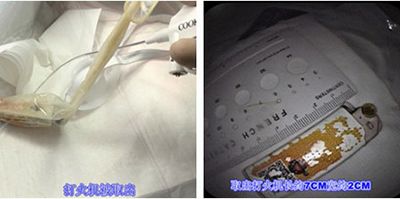 为了赢得赌约，他竟然吞下打火机！内镜医生用避孕套捞出