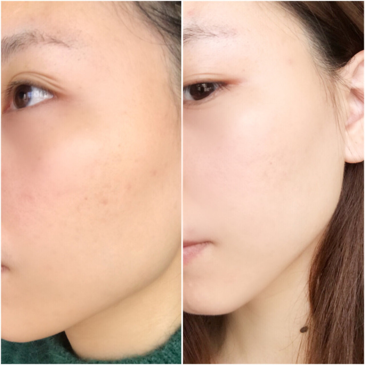 sk2的小白瓶和科颜氏淡斑精华,科颜氏美白淡斑精华sk2小灯泡