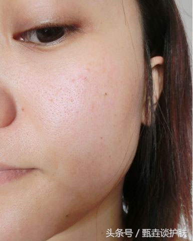 如何真正改善毛孔粗大,毛孔粗大油腻如何改善