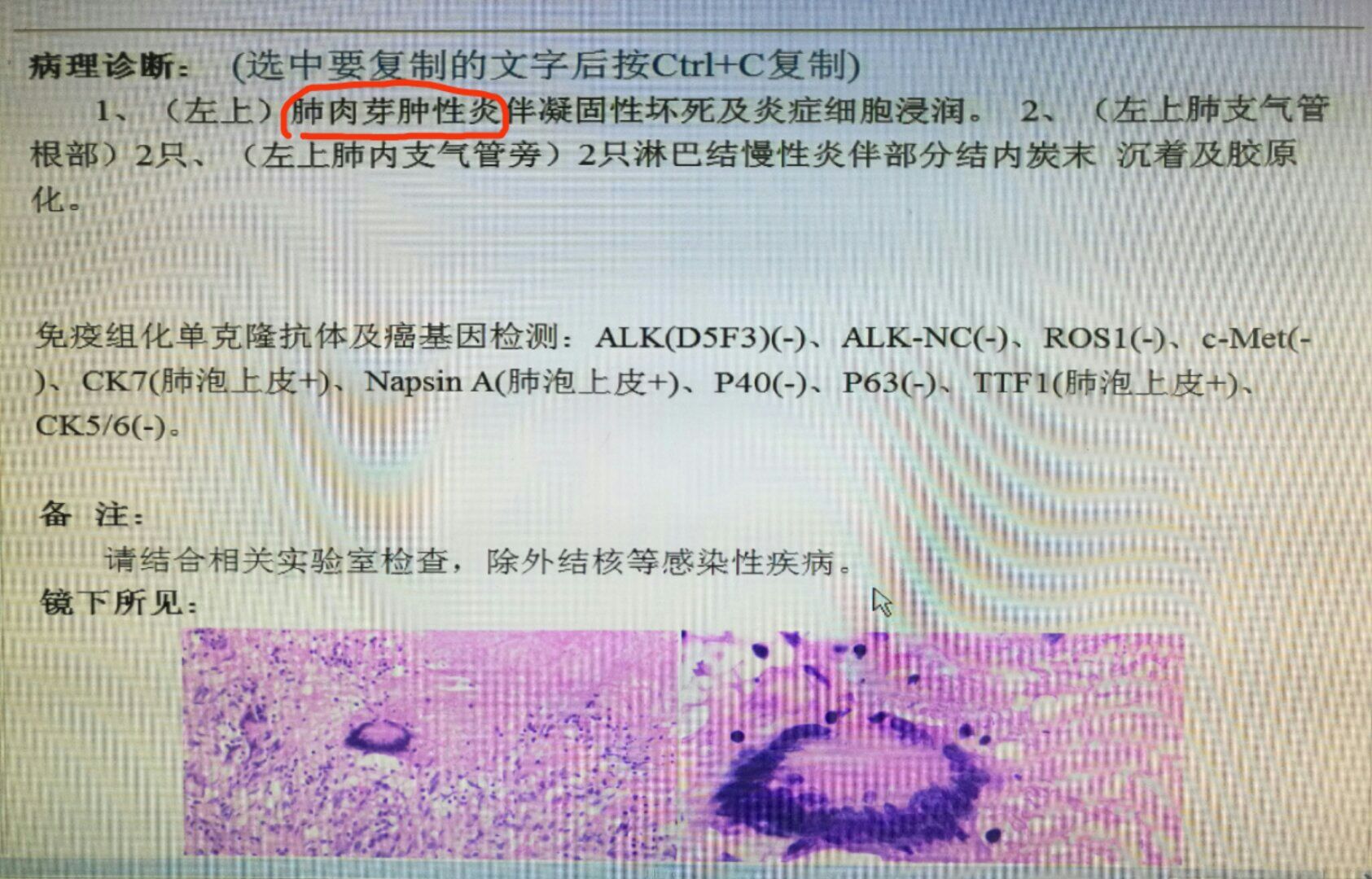 petct诊断癌症有误诊吗,petct提示癌就是癌了吗