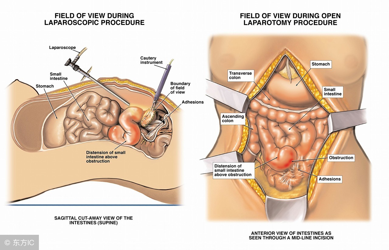 结肠癌增强ct查淋巴结转移准确率,结肠癌晚期淋巴结转移会什么后果