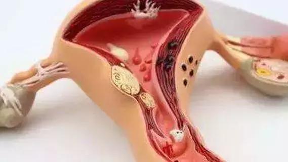 女孩宫外孕被男医生识破,宫外孕做手术的时候没找到孕囊