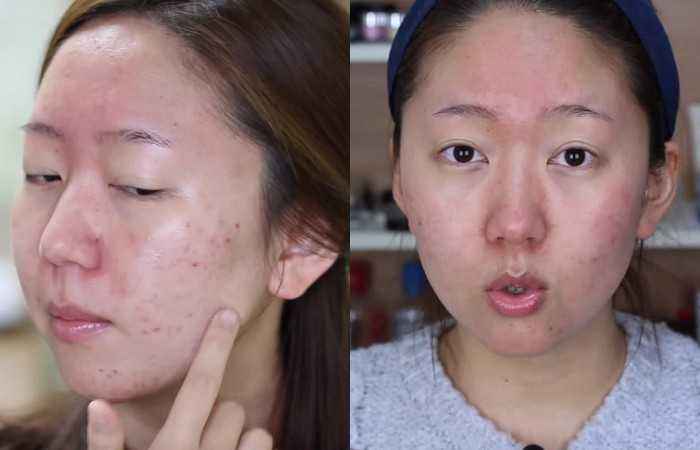 痘肌女孩子,痘痘肌女生的烦恼