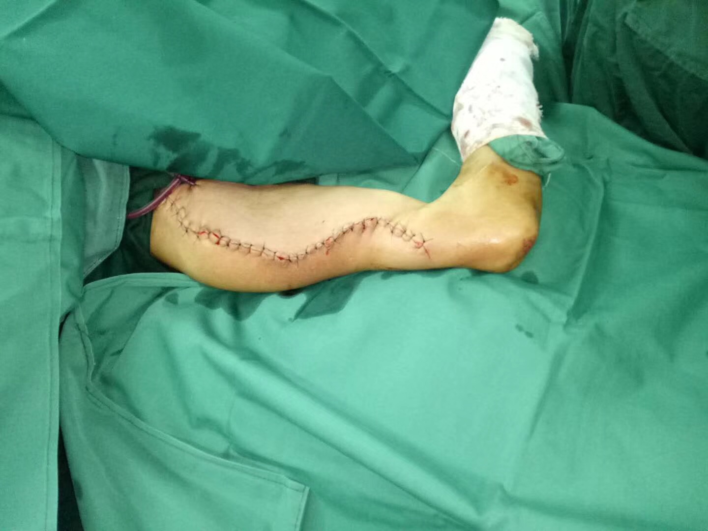 8斤重！堪比巨婴的脂肪瘤在手臂上挂了近30年！