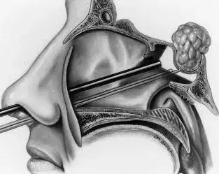 医学科普脑膜瘤的鉴别诊断及预防,脑垂体肿瘤现在有几种治疗方法