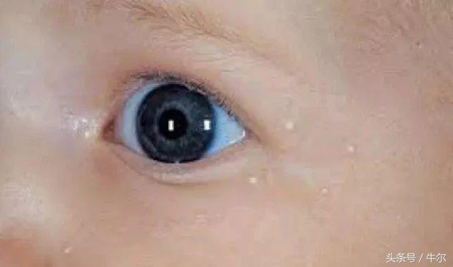 护肤品用了长脂肪粒是怎么回事,眼周护肤品不吸收起脂肪粒怎么办