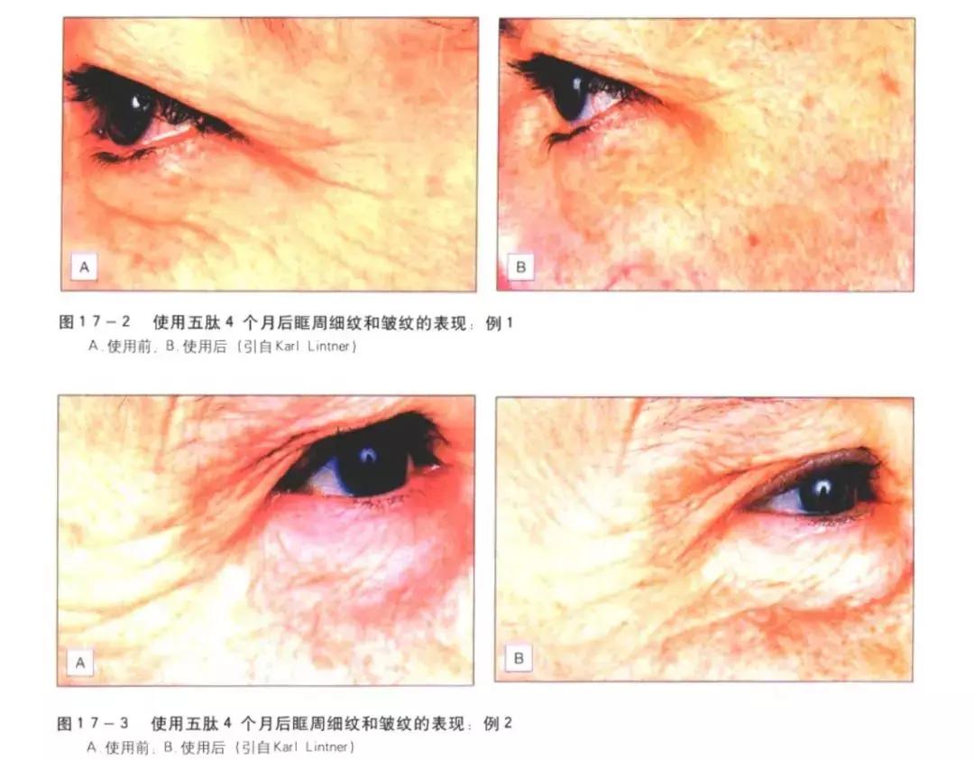 抗老抗皱纹的护肤品是真的吗,抗老紧致肉毒杆菌