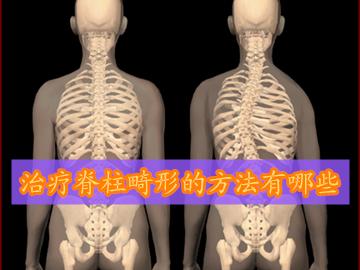 治疗脊柱畸形的方法需要患者了解清楚