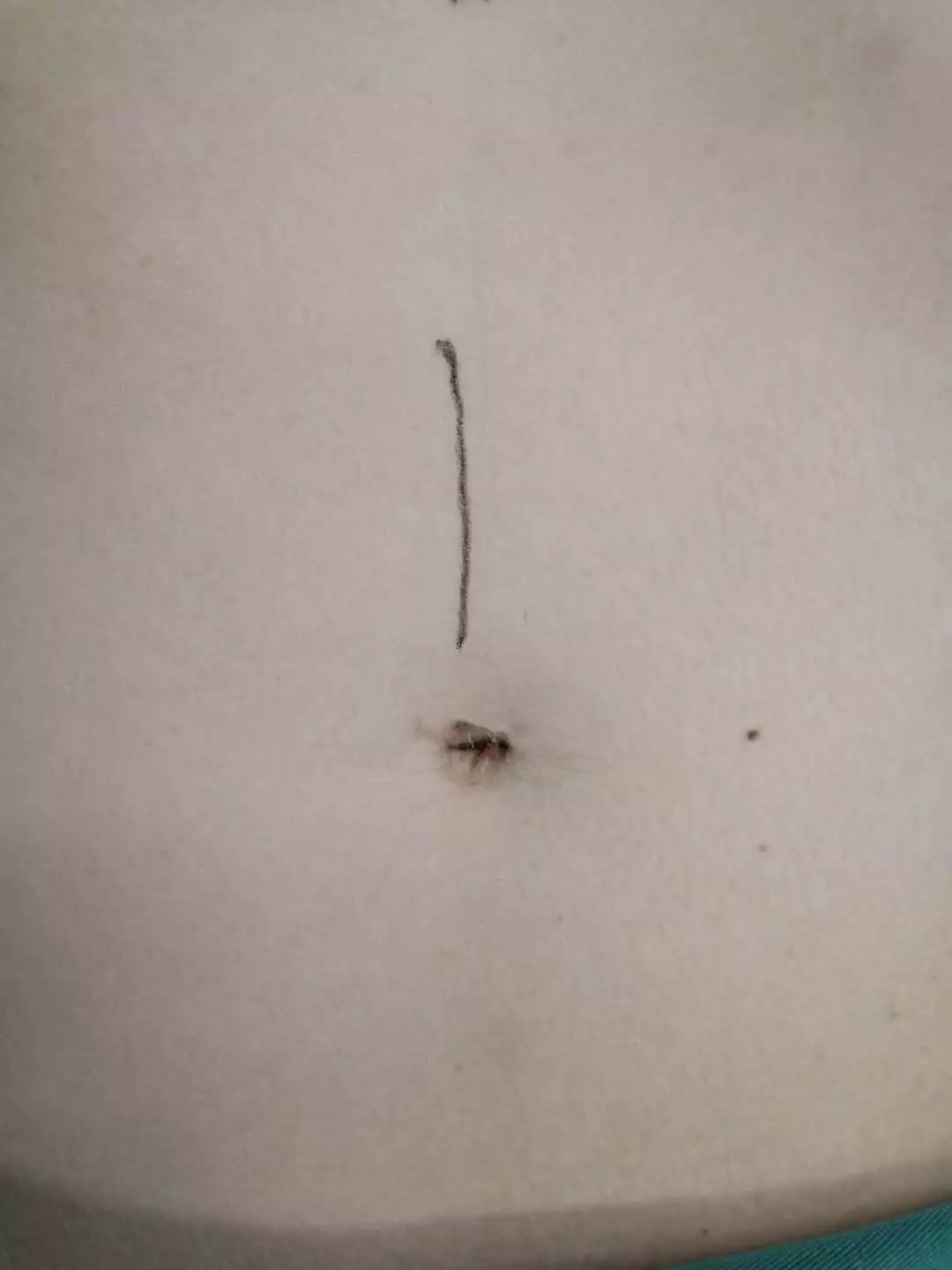 幼儿脑积水首选术式,脑积水微创术是外引流吗