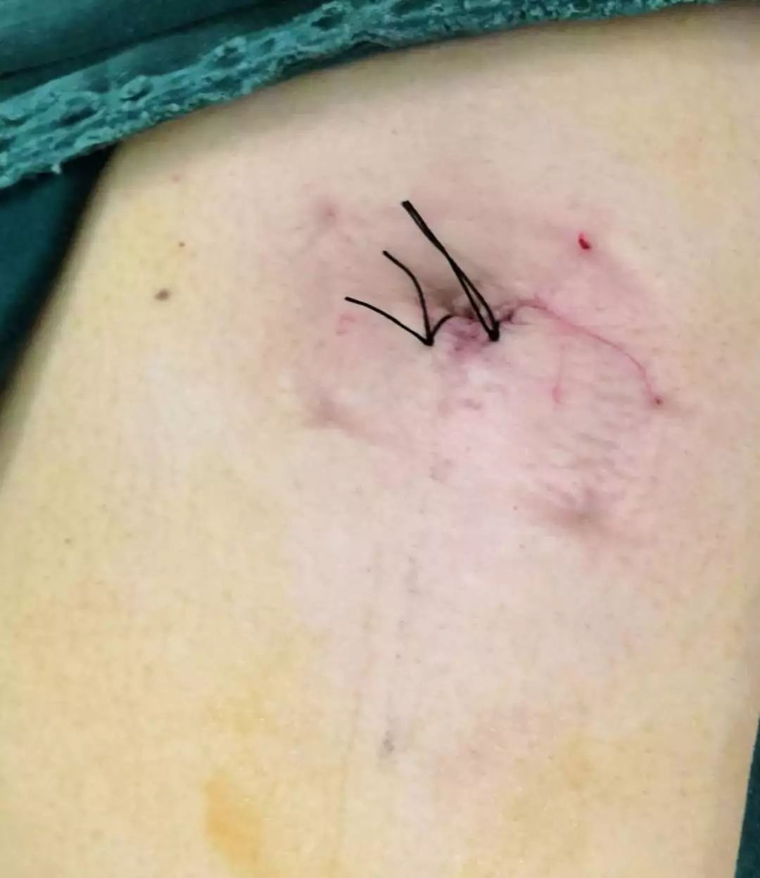 幼儿脑积水首选术式,脑积水微创术是外引流吗