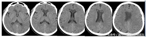 李医生讲中风,大脑前动脉堵塞的点点滴滴