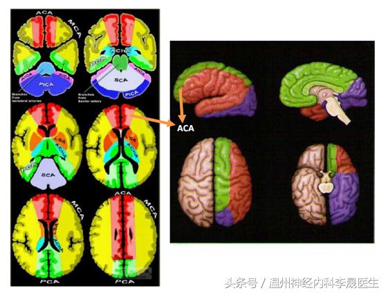李医生讲中风,大脑前动脉堵塞的点点滴滴