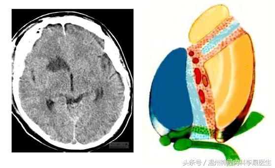 李医生讲中风,大脑前动脉堵塞的点点滴滴