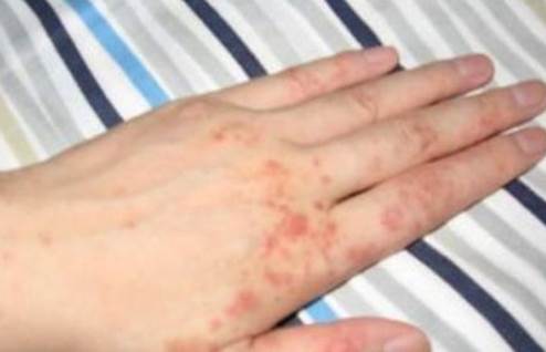 如何从根源上解决湿疹,正确认识婴儿湿疹