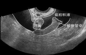 盆腔积液是一种病吗,盆腔积液是一种严重的病吗