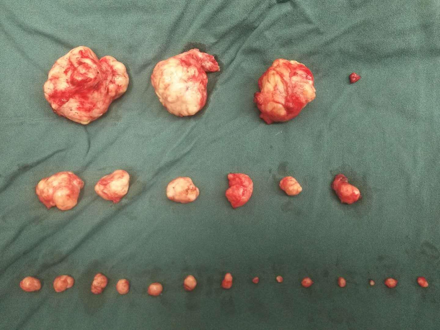 滚蛋吧肿瘤君内容简介,现实版滚蛋吧肿瘤君