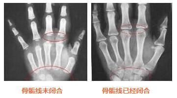 三岁女孩才79厘米,女儿三岁了才80公分怎么办