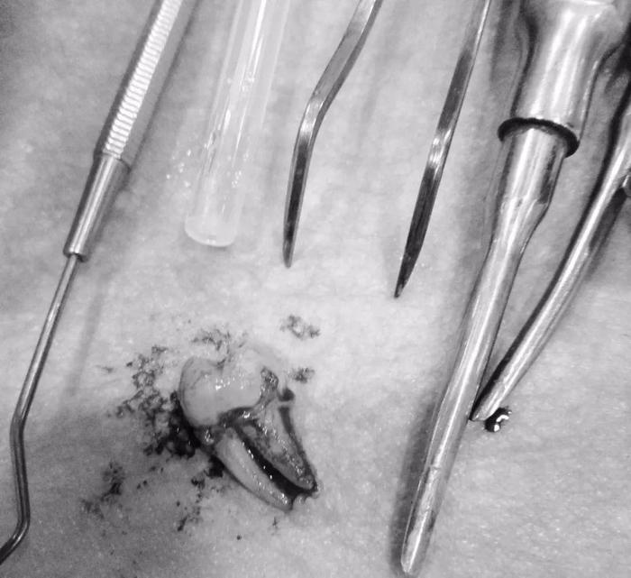 拔智齿疼还是拔大牙疼,拔智齿拔完疼吗