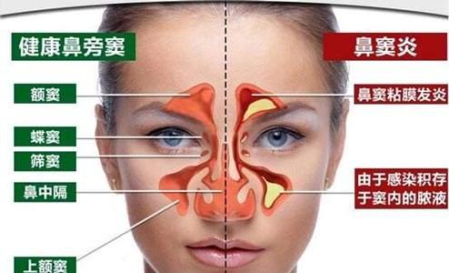 静子养生讲堂,中医如何调理慢性鼻窦炎