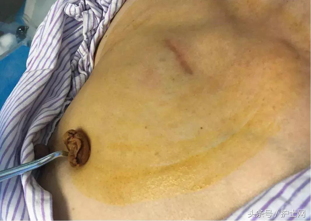 输液港扎针最全示范，再也不怕病人说技术不到位了