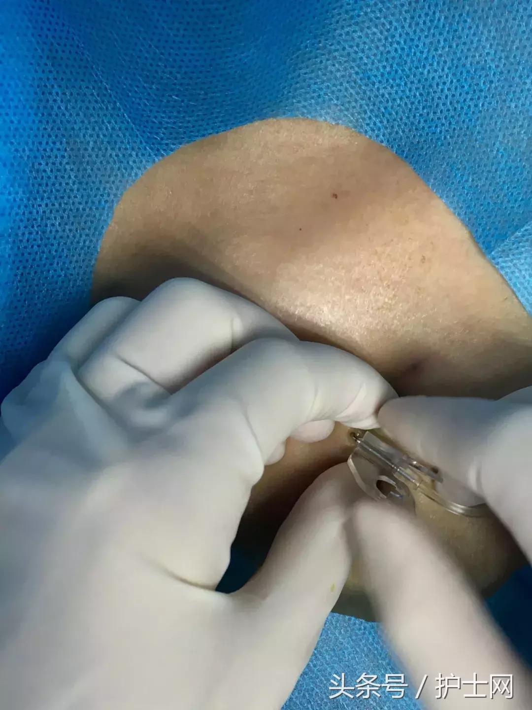 输液港扎针最全示范，再也不怕病人说技术不到位了