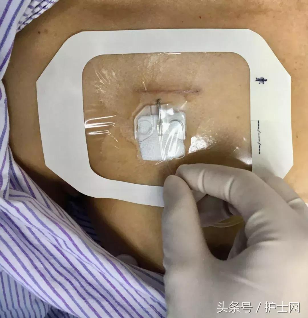 输液港扎针最全示范，再也不怕病人说技术不到位了