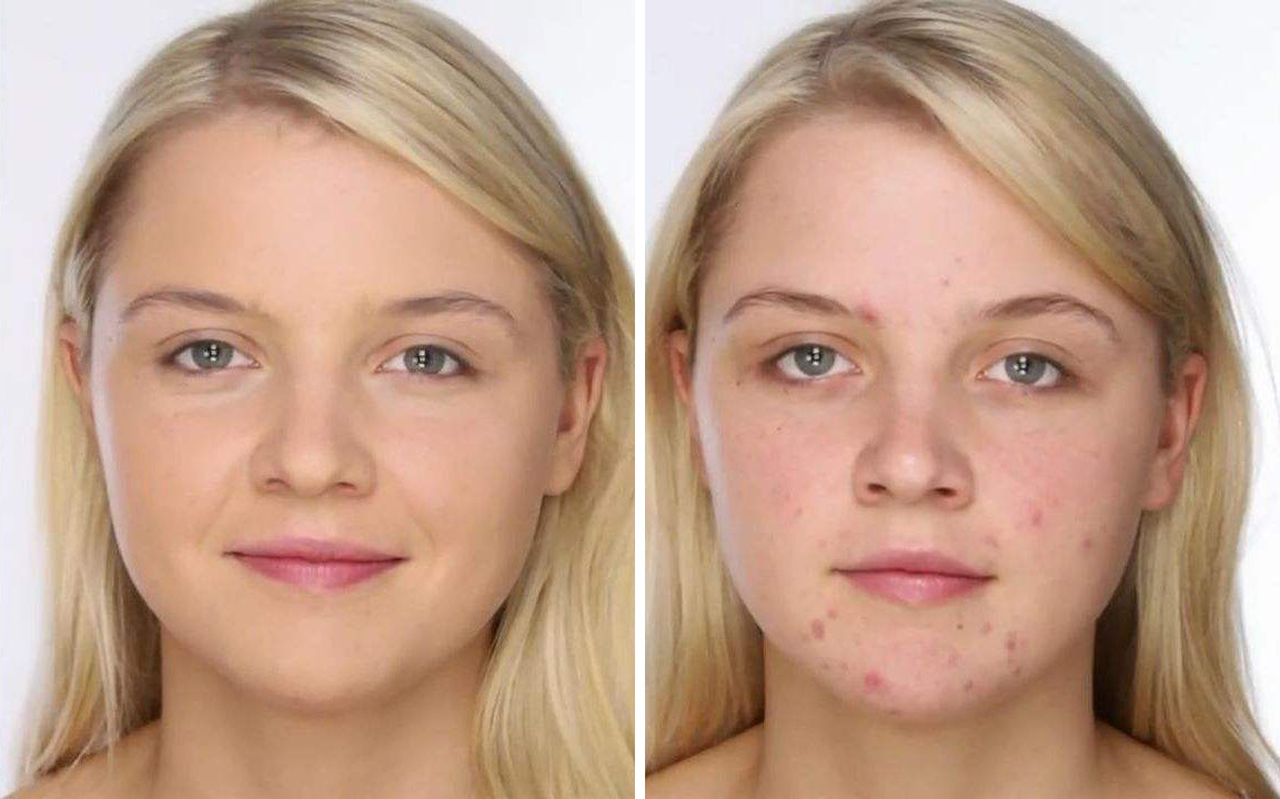 后背出油、长痘？一招教你解决！