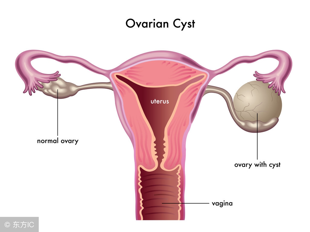 卵巢黄素化囊肿和卵巢囊肿区别,卵巢囊肿和卵巢冠囊肿有什么区别