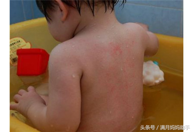 宝宝胳肢窝起红疹子什么原因,宝宝胳肢窝红图片