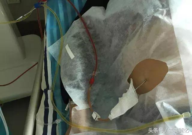 河北中医肝病医院能治肝硬化吗,河北李振台治肝硬化腹水方子