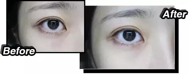 去黑眼圈推荐的眼膜,对黑眼圈和眼袋有用的眼膜