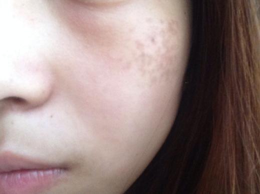 产后斑怎么消除,产后斑越来越多