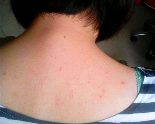 前胸后背长痘痘是什么原因引起的,前胸后背脖子长痘痘是什么原因呢
