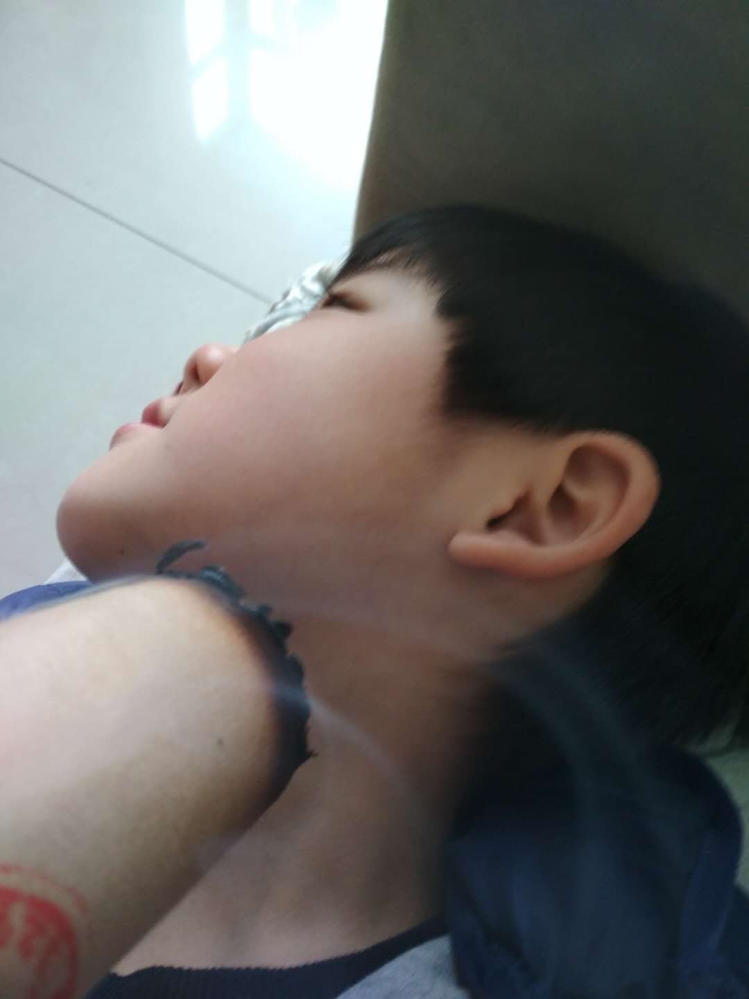 艾灸治疗鼻炎扁桃体肿大,腺样体扁桃体肥大艾灸有用吗