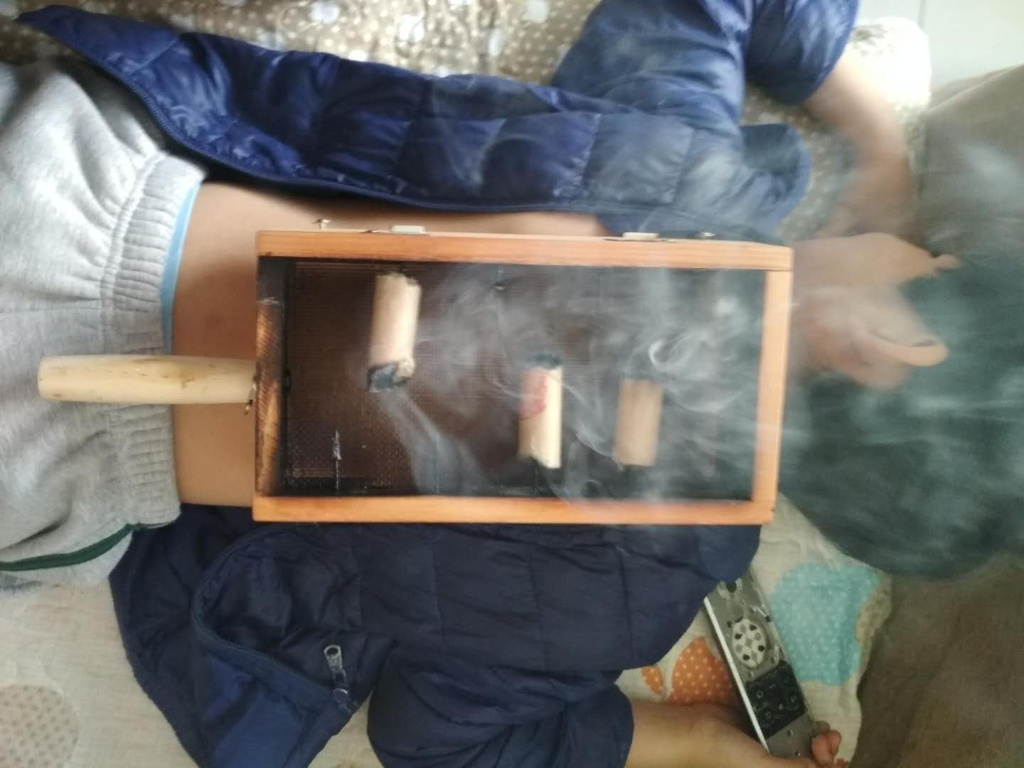 艾灸治疗鼻炎扁桃体肿大,腺样体扁桃体肥大艾灸有用吗