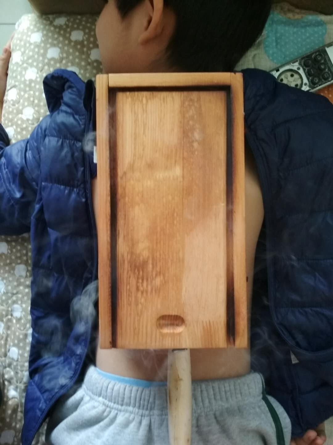 艾灸治疗鼻炎扁桃体肿大,腺样体扁桃体肥大艾灸有用吗