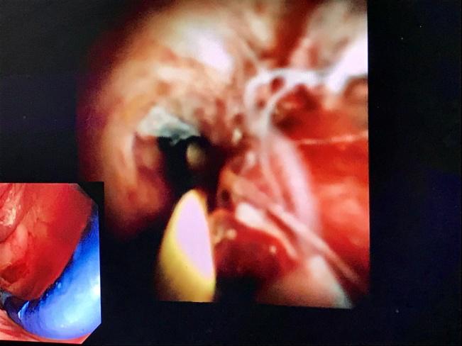 胆管末端狭窄必须做手术吗,胆管狭窄能不做支架吗