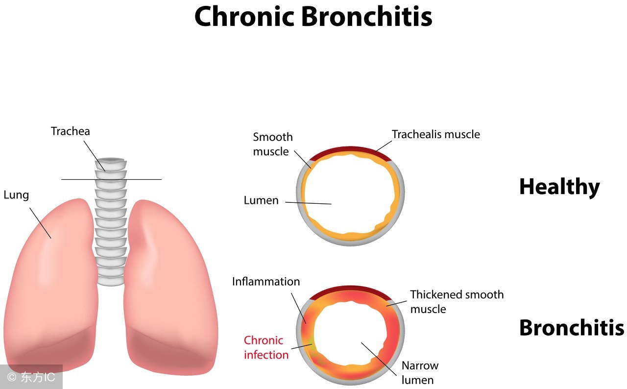 小儿急性喉气管支气管炎如何护理,急性支气管炎的护理记录单模板