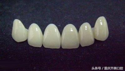 怎么判断烤瓷牙的好坏标准,怎么区分烤瓷牙的好坏图片对比