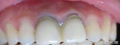 怎么判断烤瓷牙的好坏标准,怎么区分烤瓷牙的好坏图片对比