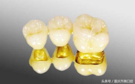 怎么判断烤瓷牙的好坏标准,怎么区分烤瓷牙的好坏图片对比