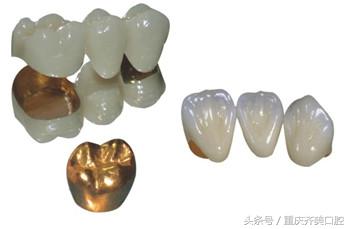怎么判断烤瓷牙的好坏标准,怎么区分烤瓷牙的好坏图片对比
