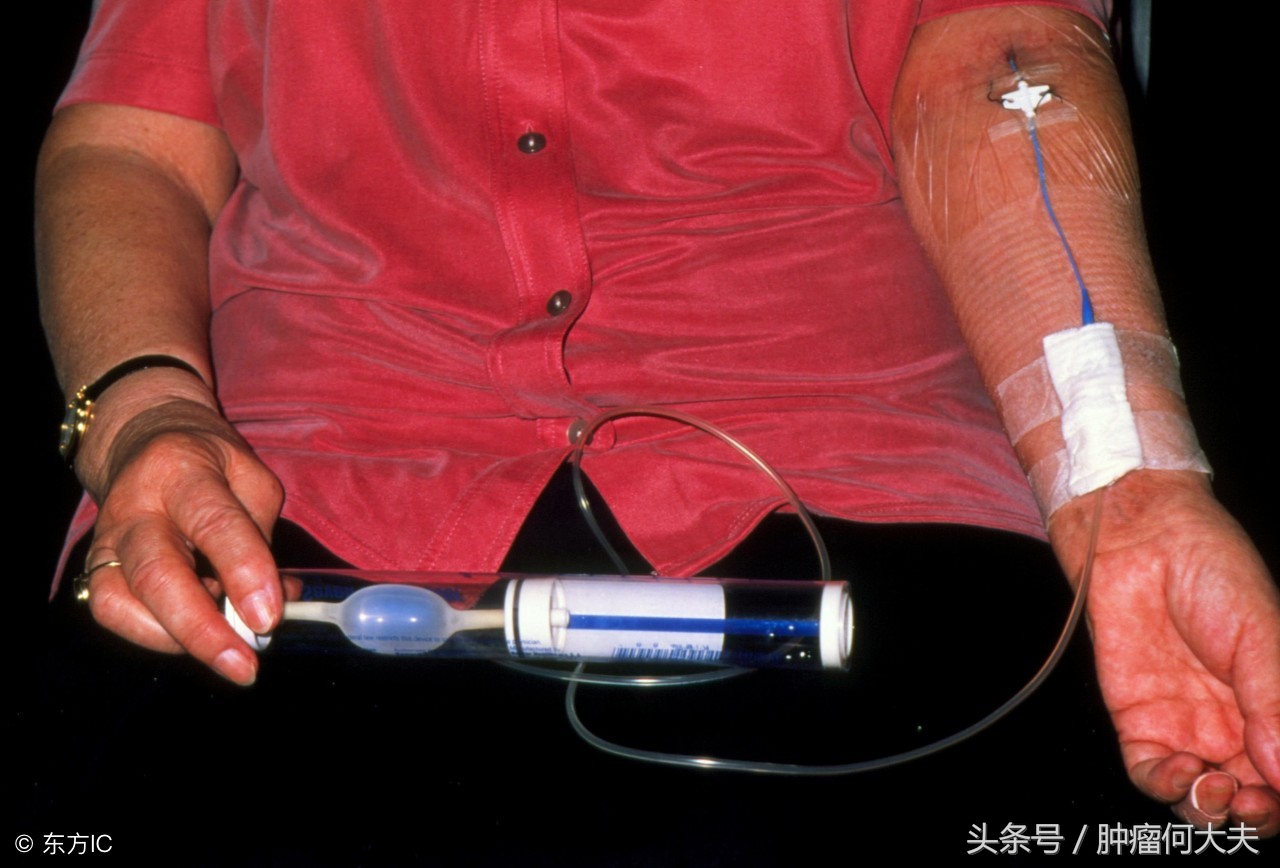 “想再多活几个月”,对一位卵巢癌晚期患者的愿望,我们初战告捷