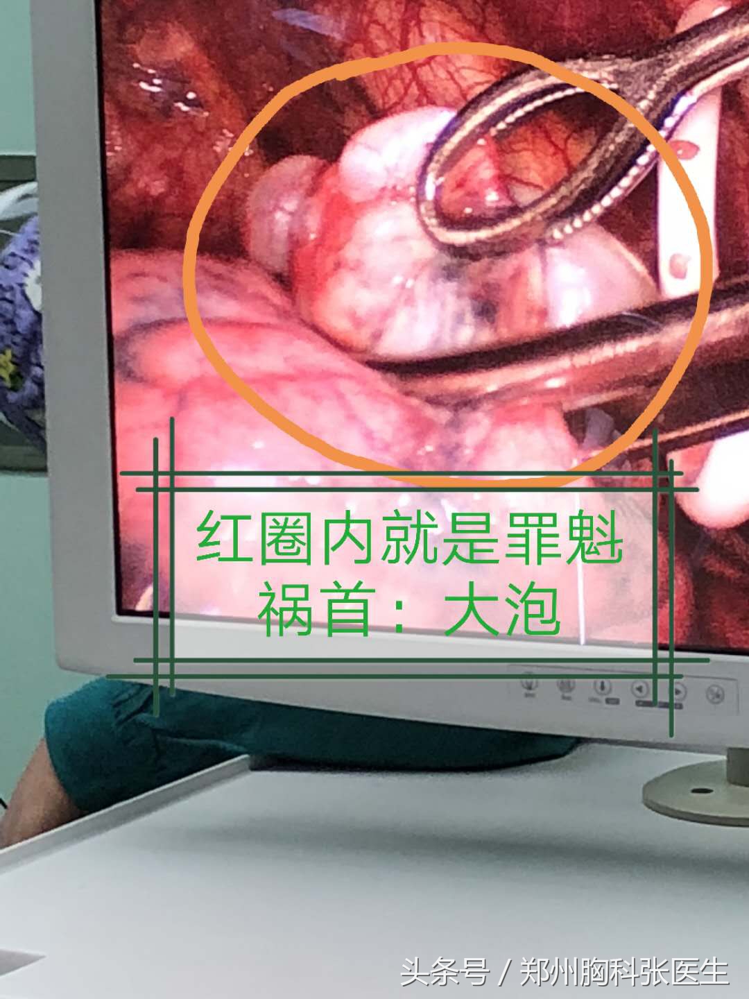 专家讲解关于气胸的知识,如何预防气胸一定要注意这四点