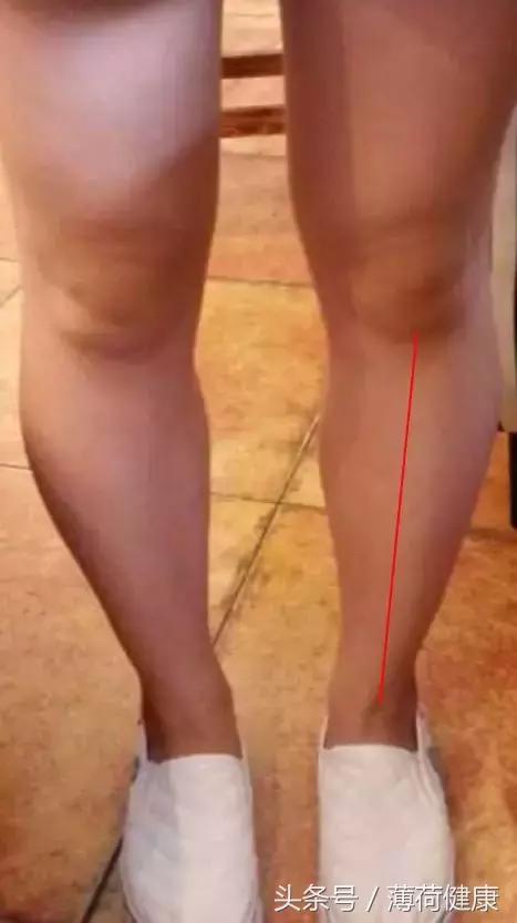 走路时注意什么改善小腿外扩,长期跑步可以纠正小腿外扩吗