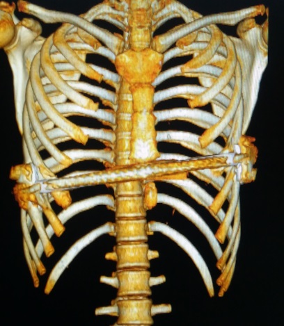 漏斗胸矫正微创手术,最新的漏斗胸微创手术