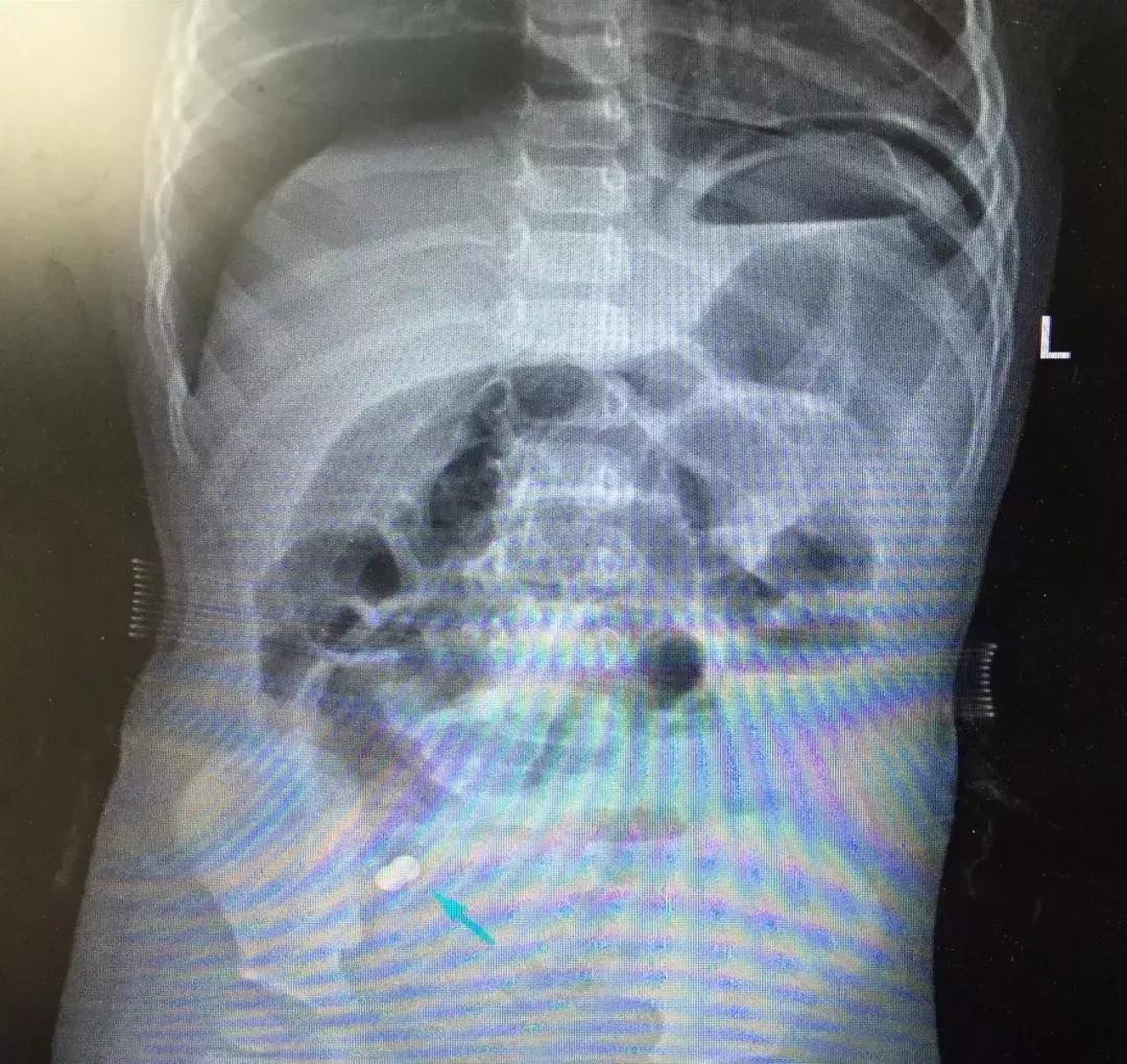 女娃误吞磁力珠致6处肠穿孔,小孩误吞磁力珠